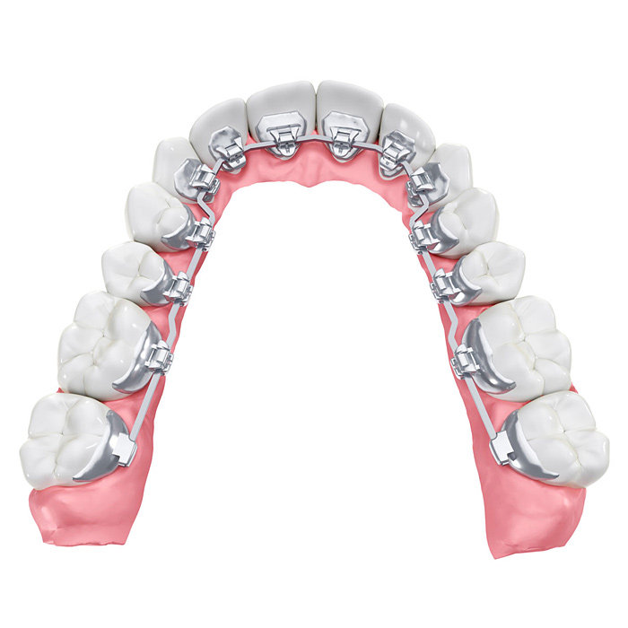 Лингвальная брекет-система
